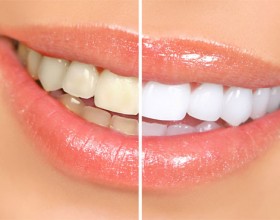 Prix Jamais-Vu: Des dents blanches pour un sourire radieux au prix exceptionnel de 250dhs chez Beauty Smile!