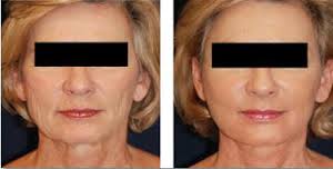 soin lifting plus contour des yeux (microdermabrasion et radiofrequence )