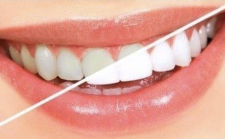 Blanchiment de dents  en cabinet dentaire